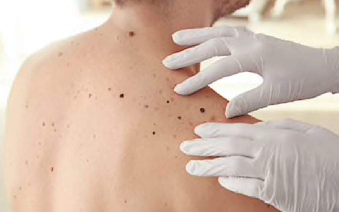 Haute-Corse : un véritable désert médical pour la dermatologie Haute-Corse : un véritable désert médical pour la dermatologie