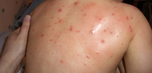  Corse : Attention à la varicelle