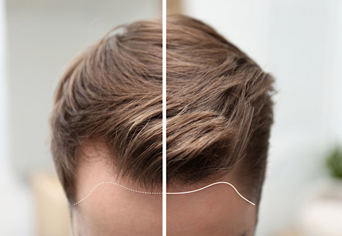 3 raisons de recourir à une implantation capillaire 3 raisons de recourir à une implantation capillaire