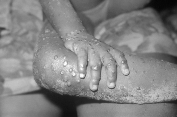 Monkeypox "Variole du singe": un premier cas confirmé en Corse Monkeypox "Variole du singe": un premier cas confirmé en Corse