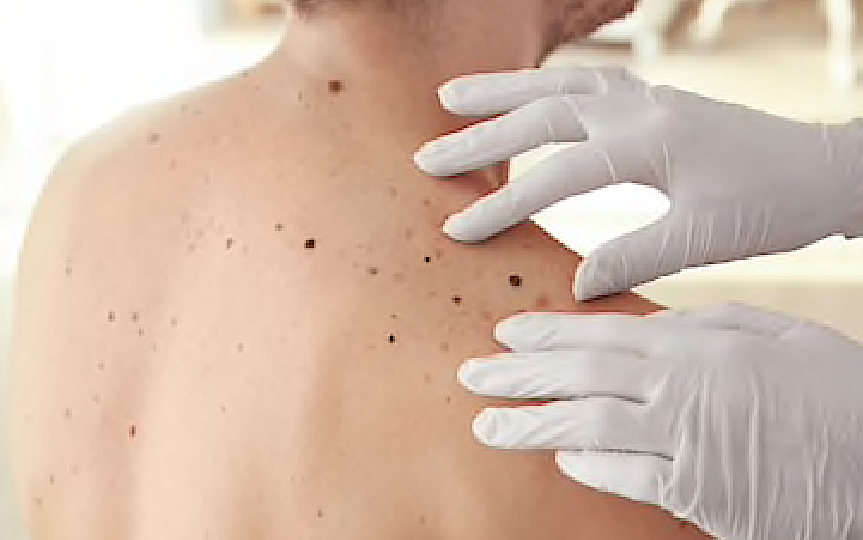Haute-Corse : un véritable désert médical pour la dermatologie