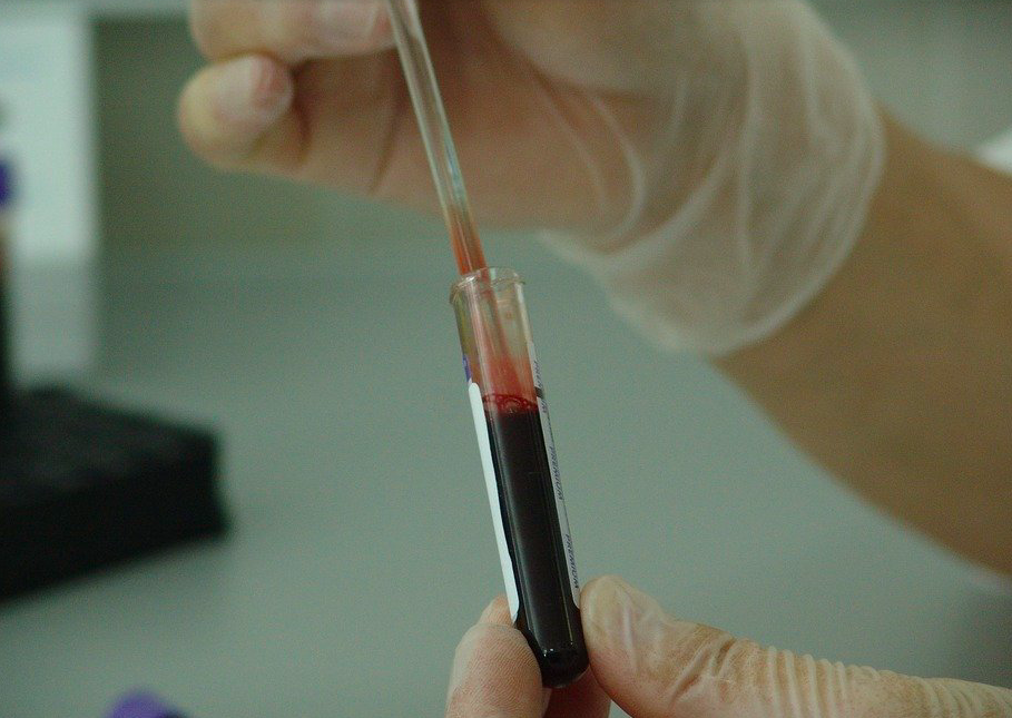  Les tests de dépistage du Sida en chute libre en Corse : "2021 sera catastrophique"