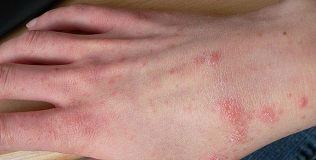 Ghisonaccia : Deux cas de gale à l'école maternelle