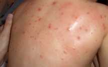  Corse : Attention à la varicelle