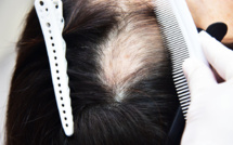 3 raisons de recourir à une implantation capillaire