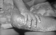 Monkeypox  "Variole du singe": un premier cas confirmé en Corse