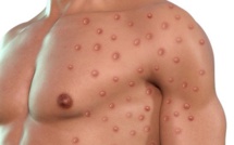 Un troisième cas de variole du singe confirmé en Corse